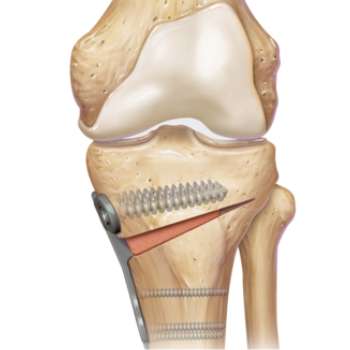 Knee Surgery - Saishree Hospital