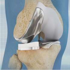 Unicompartmental Knee Replacement Saishree Pune