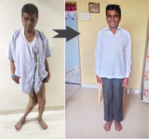 Walking Tall: Shukracharya’s Inspiring Journey to a Straight Knee